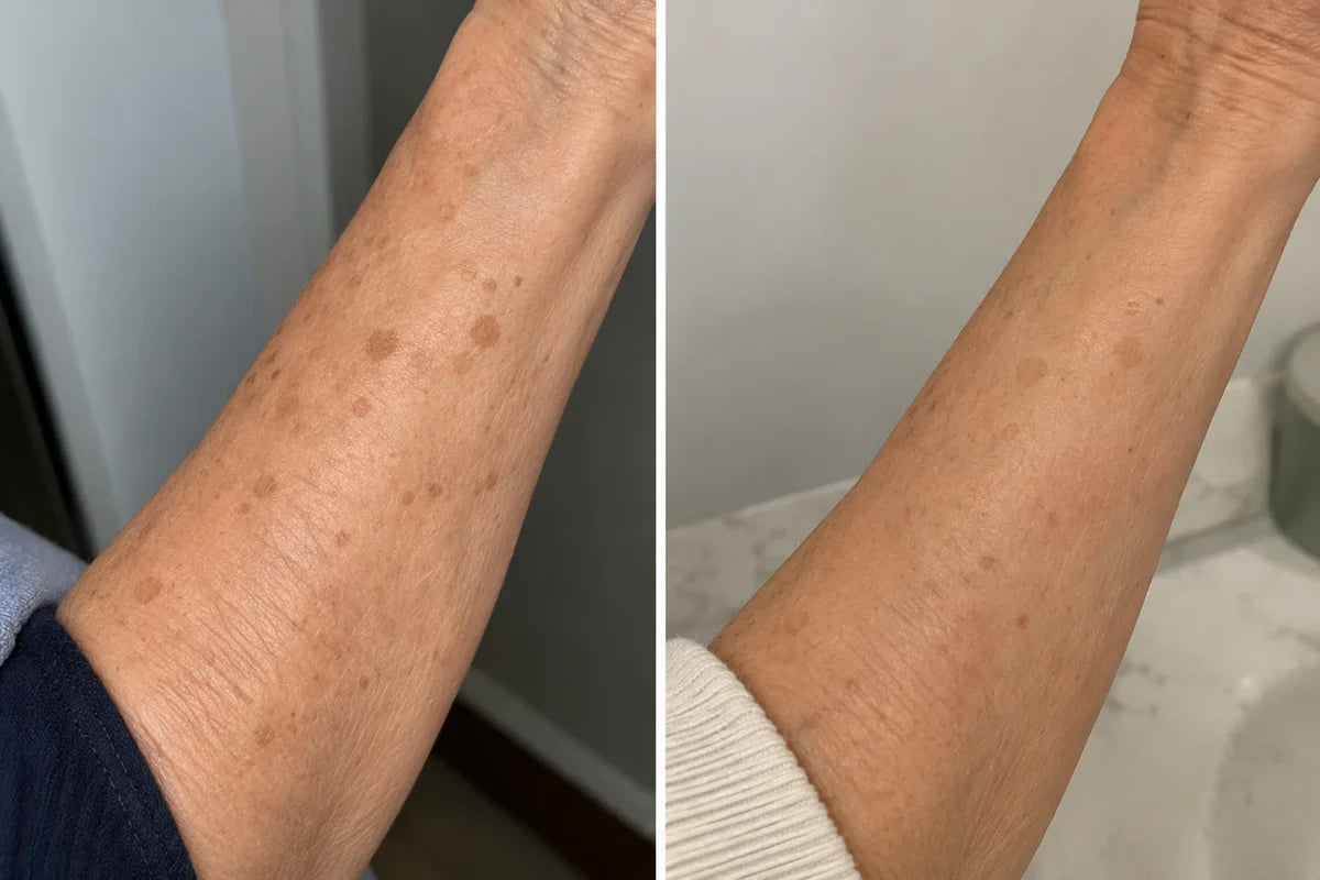 Before and after photo showing dark spots on a forearm