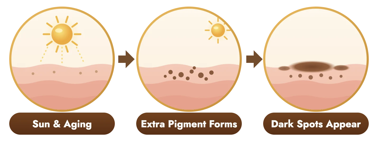 Diagram: sun and aging lead to extra pigment in the skin, which shows up as dark spots